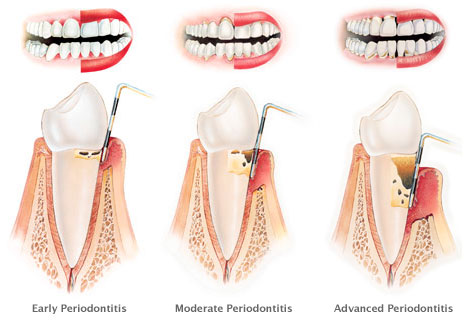 Bone loss in different periodontitis stages